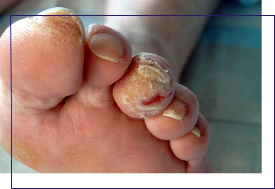 Tratamento de fissuras nos pés em Cubatão na Clínica Arte Pé
