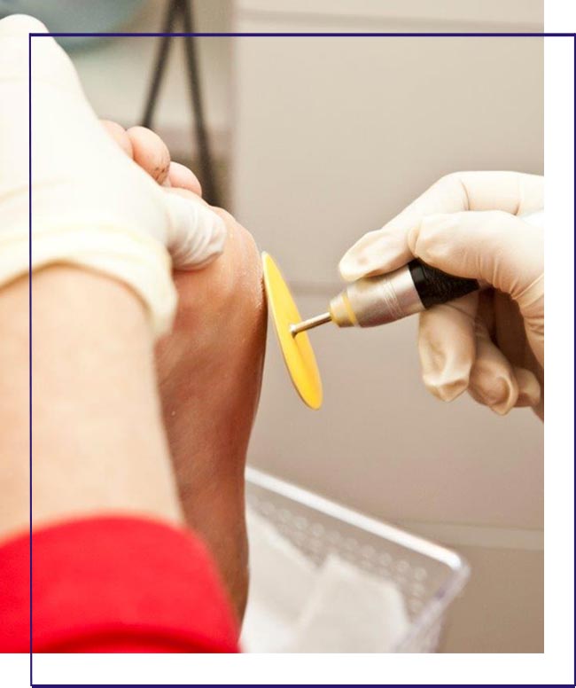 Remoção profissional de calos nos pés em Cubatão