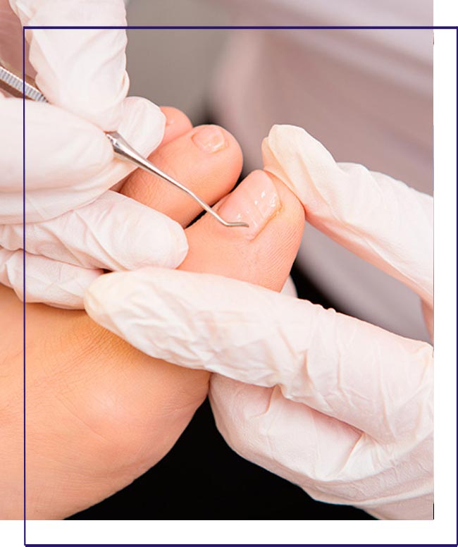 Tratamento para unhas encravadas em Cubatão - Clínica Arte Pé