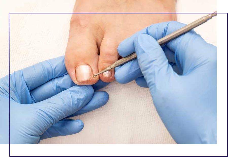 Tratamento para unhas infeccionadas em Cubatão - Arte Pé